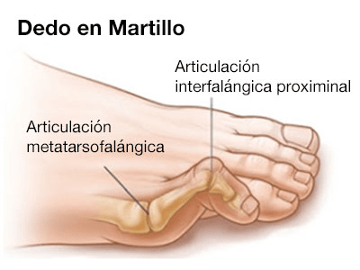 Qué es el dedo martillo y cómo aliviarlo con el calzado adecuado