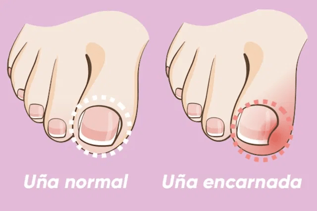 uñas encarnadas