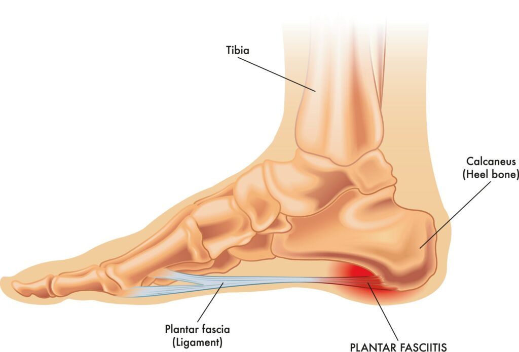 fascitis plantar