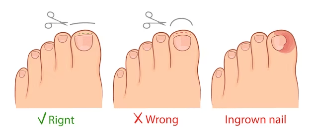 uñas encarnadas